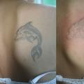 Как избавиться от татуировки без шрамов?