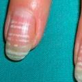Причины возникновения белых пятен на ногтях пальцев рук