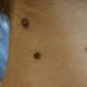 Dangerous moles on children's face and body The child's birthmark increases